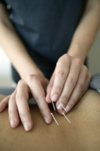 acupuncture2-199x300